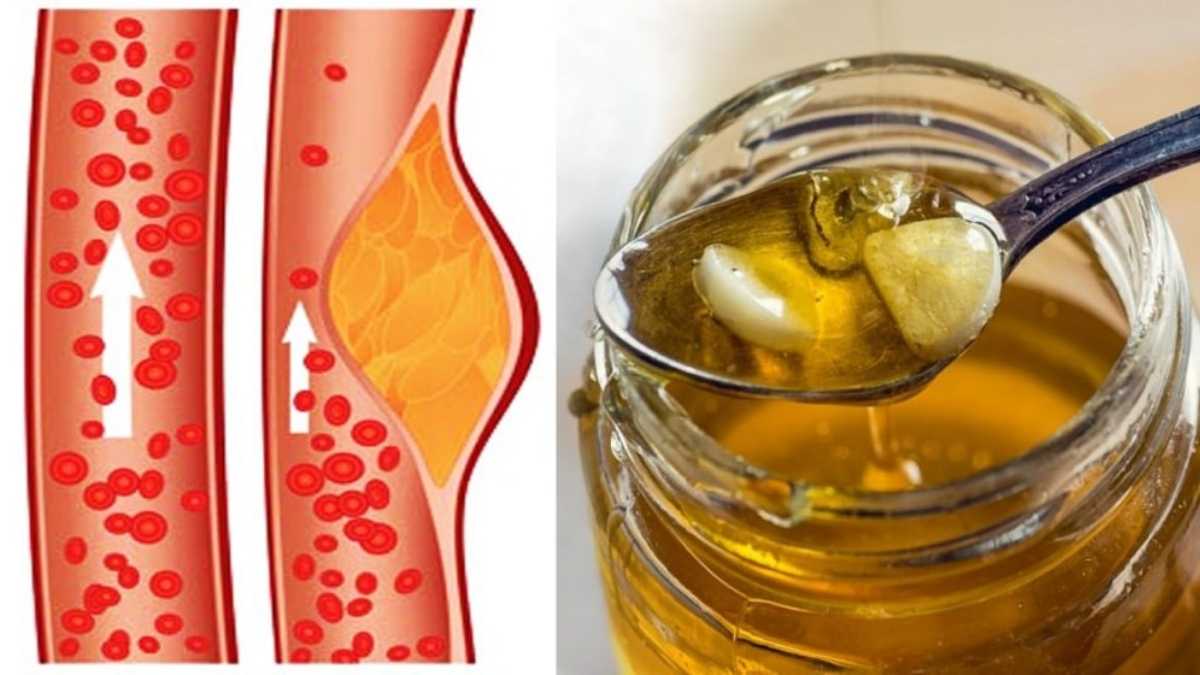 Gingembre, ail et miel : un remède puissant pour réduire le taux de cholestérol élevé
