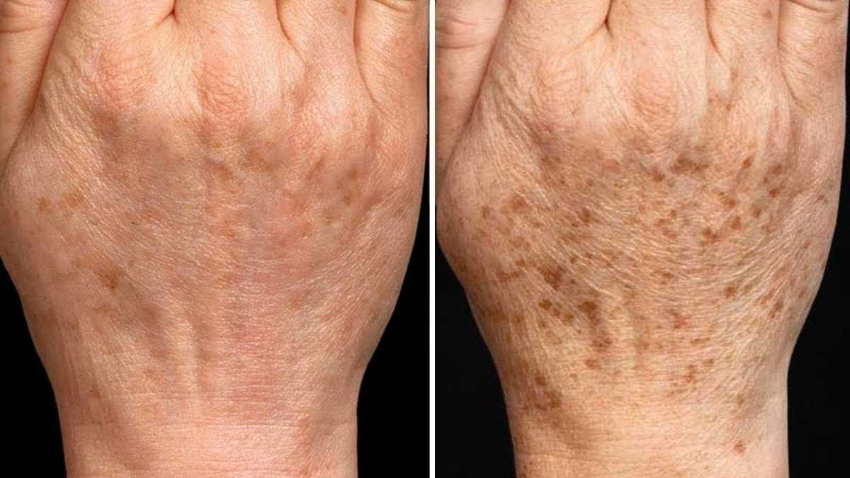 7 astuces pour se débarrasser naturellement des taches brunes sur la peau